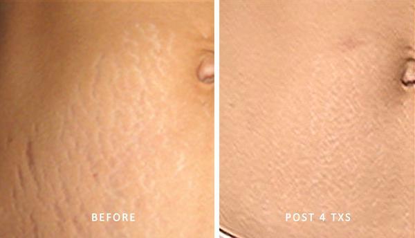 LIYALAN Stretch Mark Repair Cream