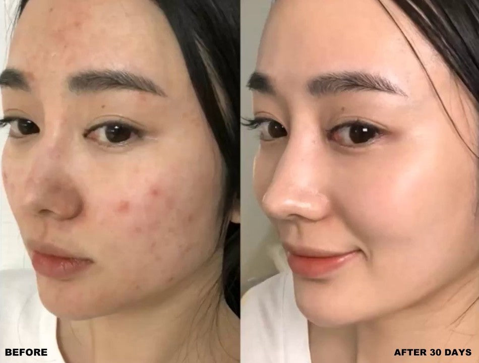 LIYALAN AHA 30% + BHA 3% Peeling Solution