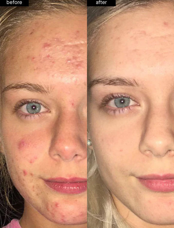LIYALAN Saliylic Acid Ice Cream Mask