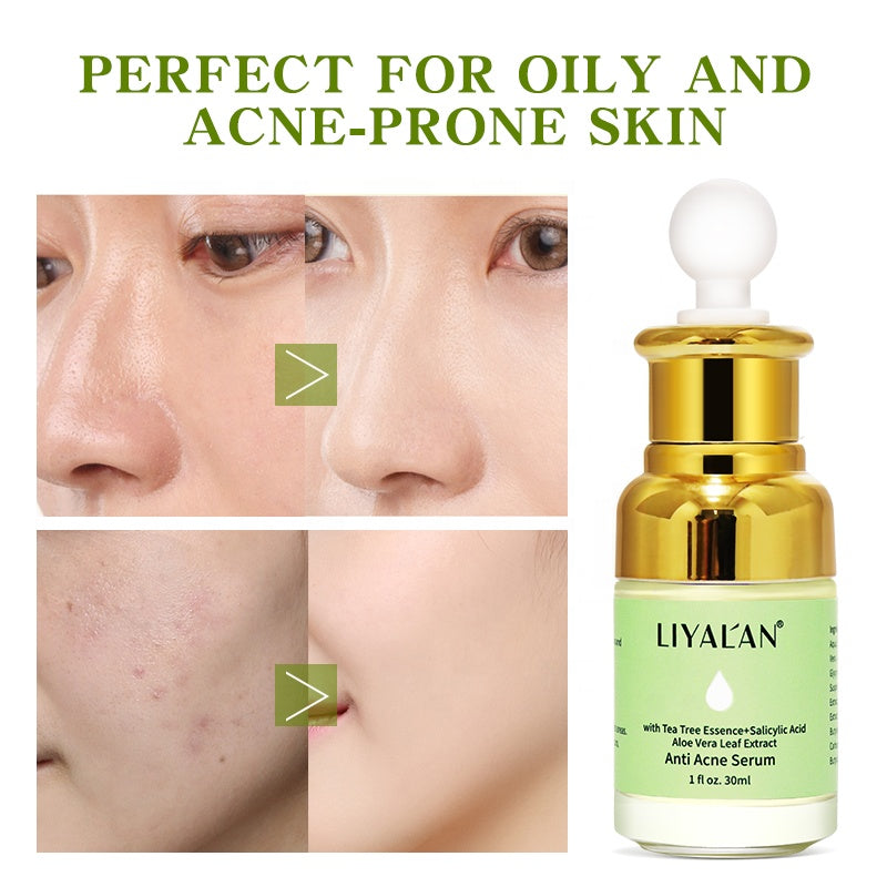 LIYALAN Anti-Acne Serum