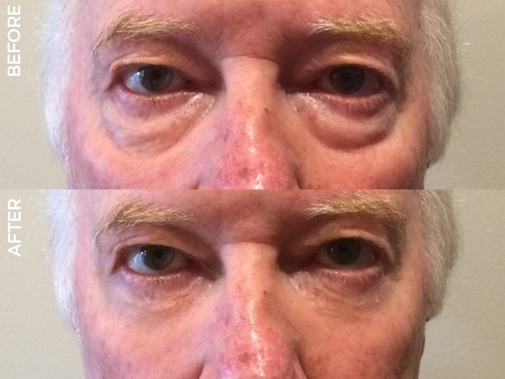 LIYALAN Instant Eye Lift