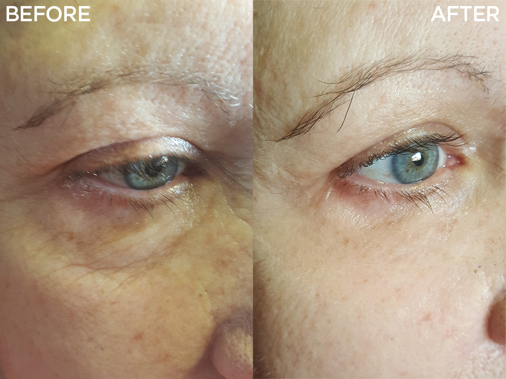 LIYALAN Instant Eye Lift