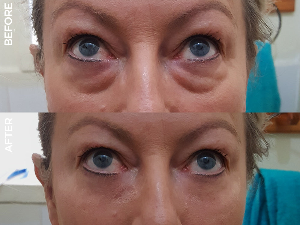 LIYALAN Instant Eye Lift