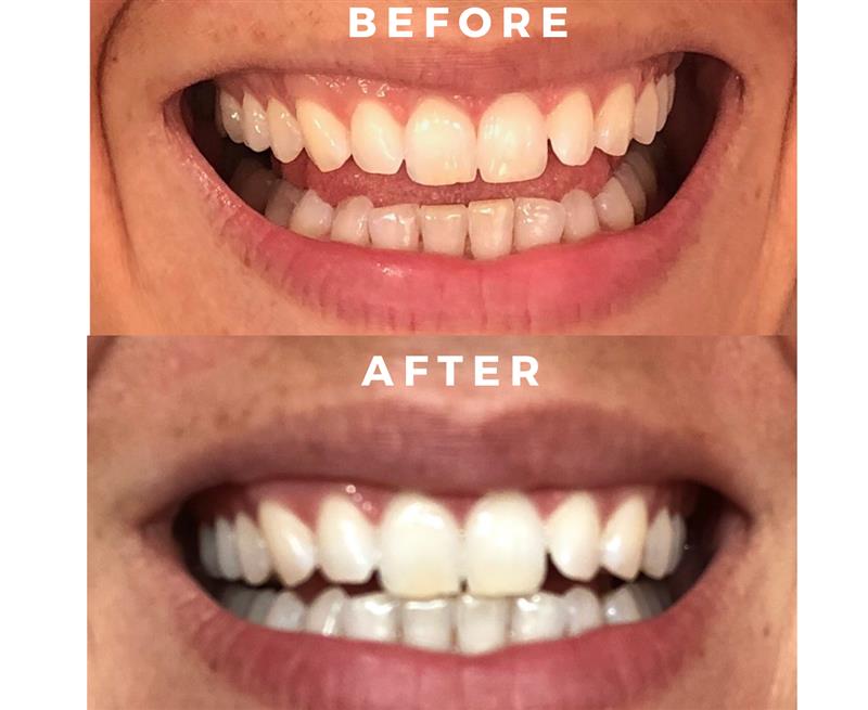 IVISMILE Charcoal Whitening Mouthwash