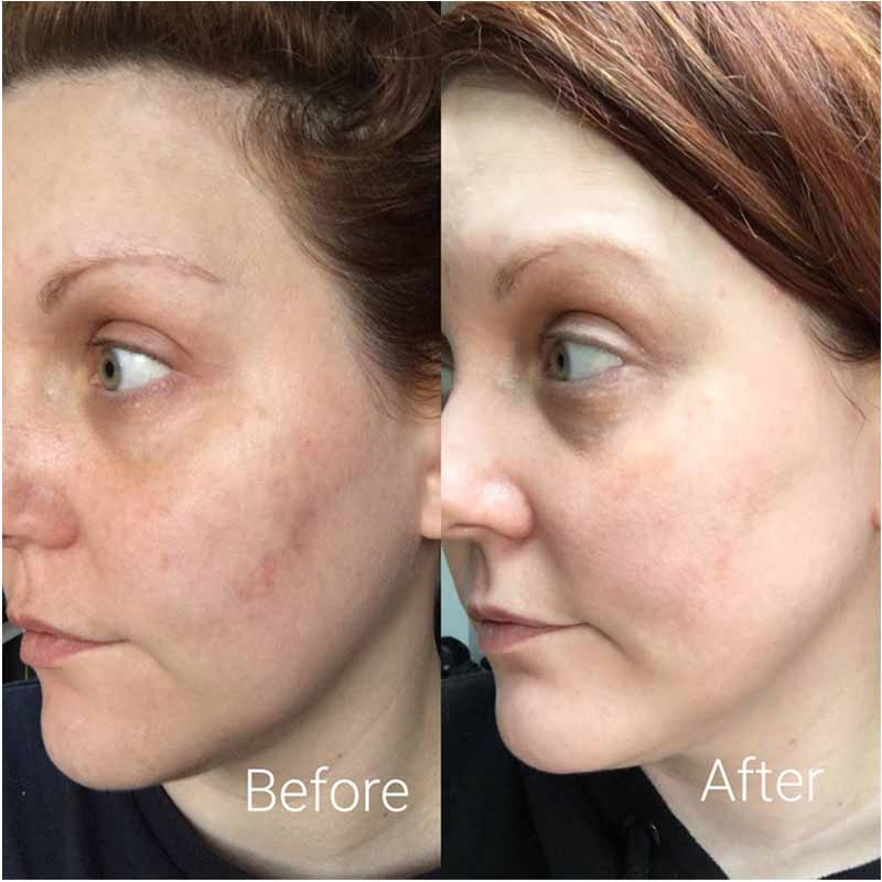 LIYALAN B5 Serum