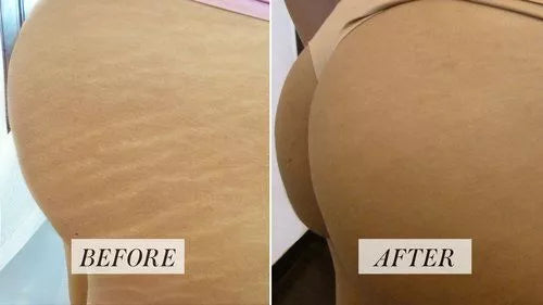 LIYALAN Stretch Mark Repair Cream