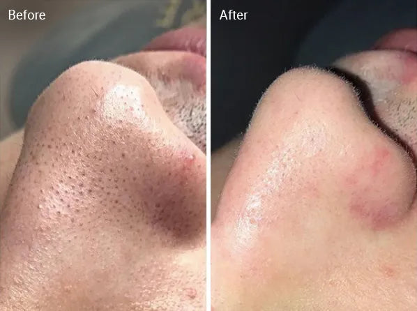 LIYALAN Blackhead Extraction and Pore Reducing Kit