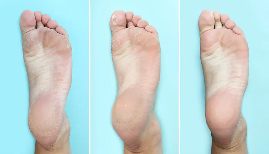 LIYALAN Baby Foot Peel Mask