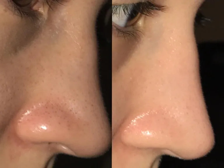 LIYALAN Blackhead Extraction and Pore Reducing Kit