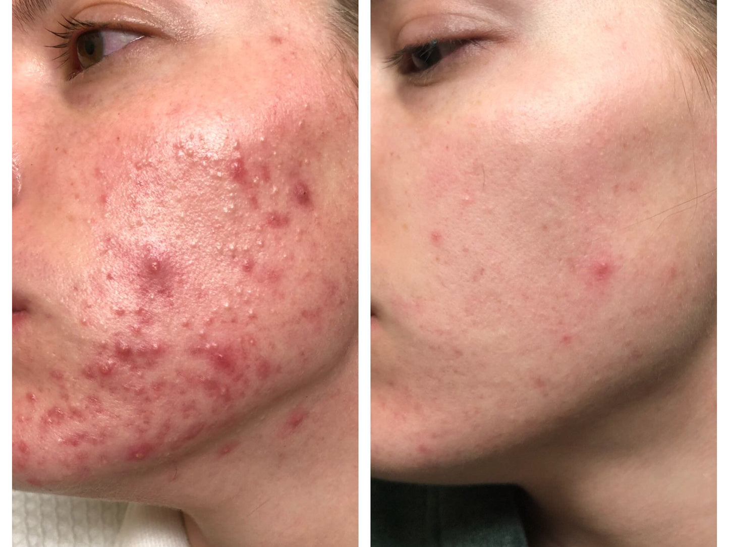 LIYALAN Hemp Inflammation Relief Face Cream