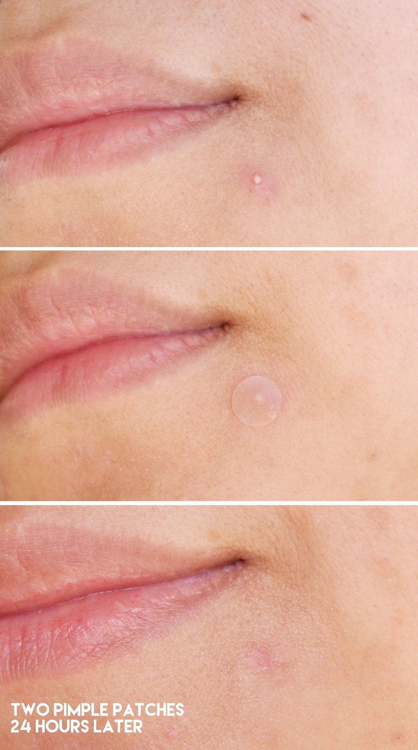 LIYALAN Acne Patches