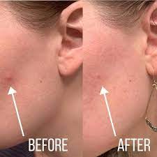 LIYALAN Acne Patches