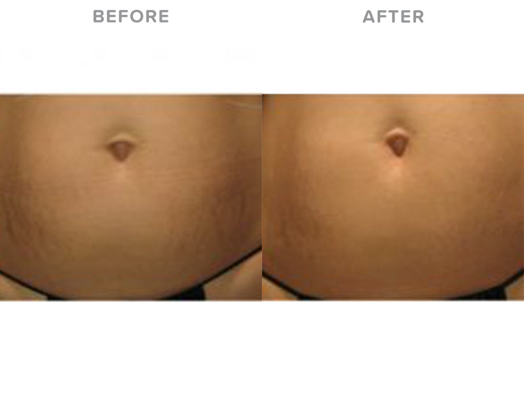 LIYALAN Stretch Mark Repair Cream