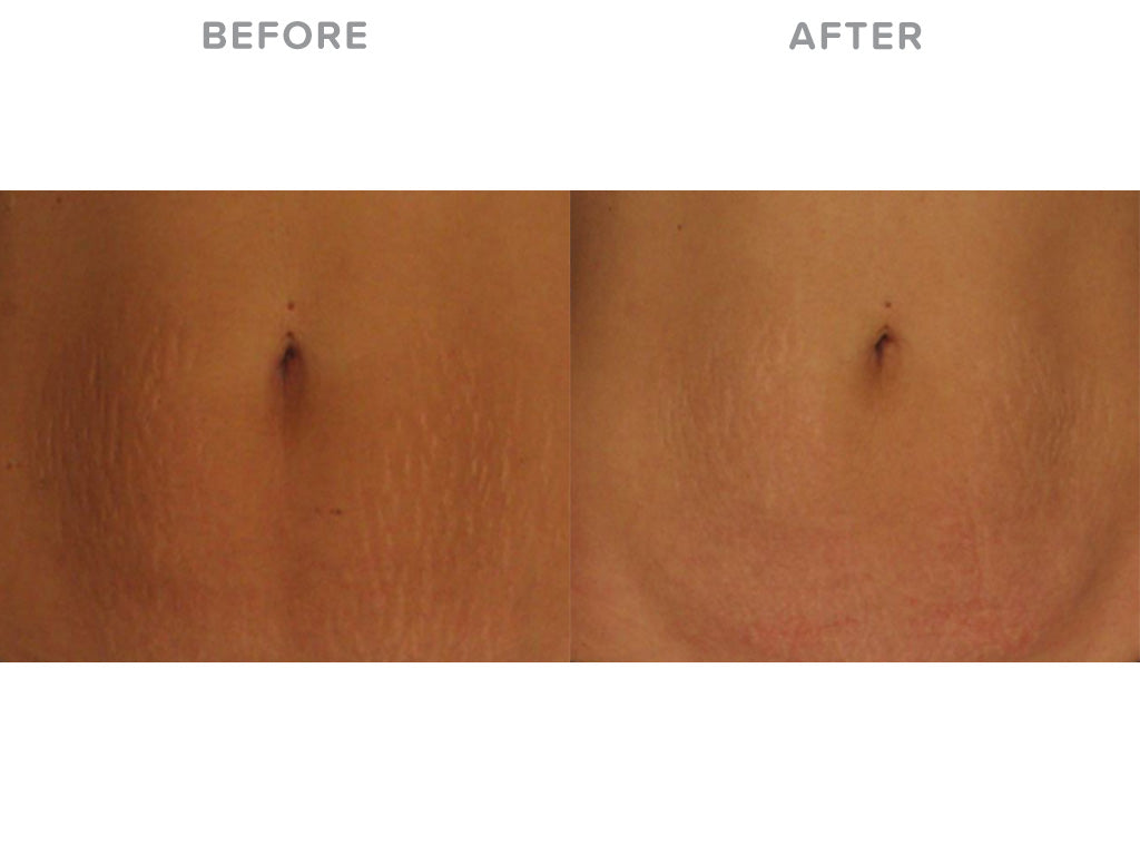 LIYALAN Stretch Mark Repair Cream