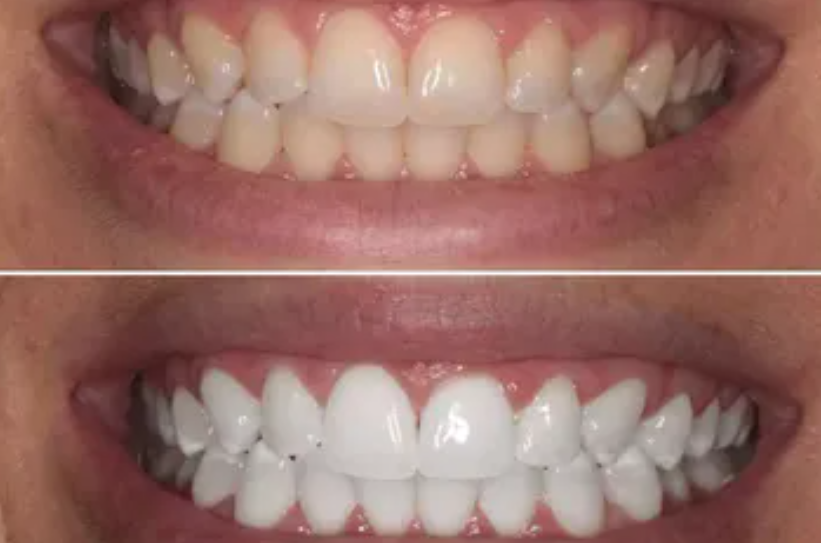 IVISMILE Teeth Whitening USB LED Kit 3.0