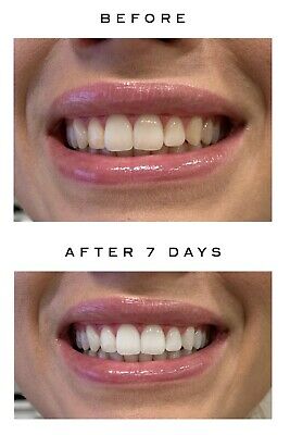 IVISMILE Teeth Whitening Foam
