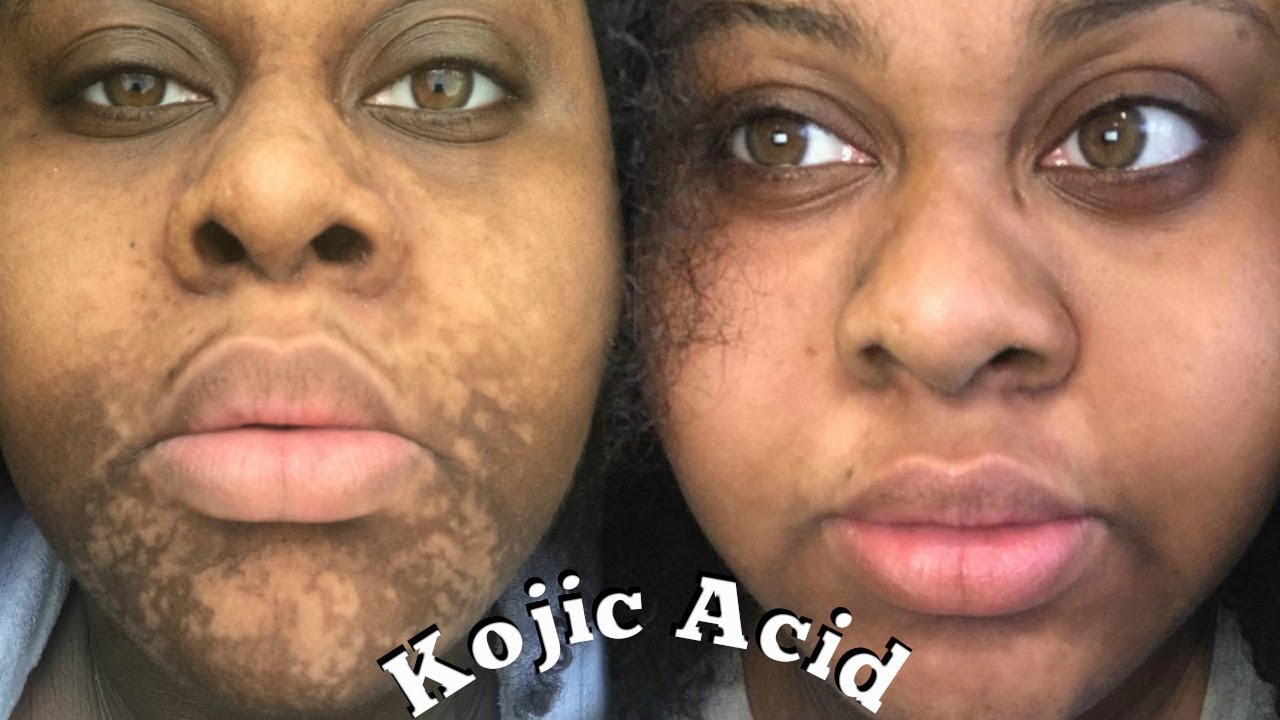 LIYALAN Light and Glow kojic acid soap